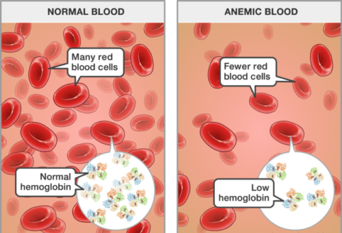 Anemia, Anemia Symptoms, Cause and Prevention of Anemia, symptoms of Anemia, How to prevent Anemia, Cure Anemia, What are the symptoms of Anemia, Diagnosis of Anemia